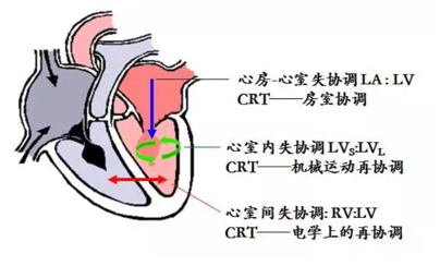 心血管病的最后战场，心衰器械治疗新进展