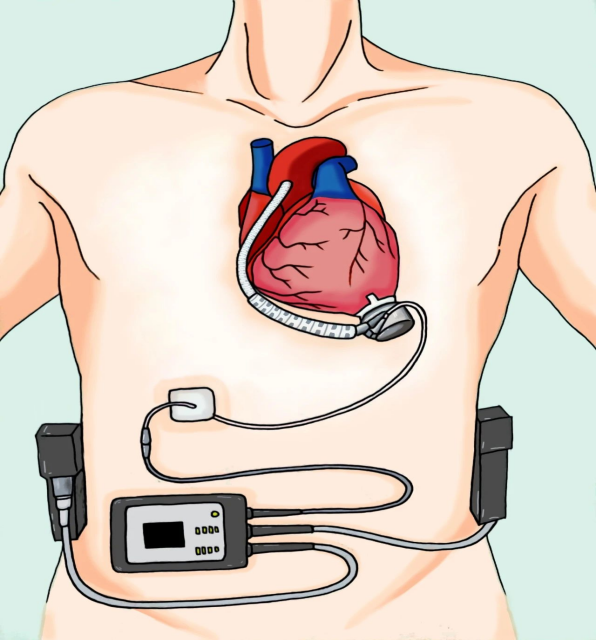心血管病的最后战场，心衰器械治疗新进展