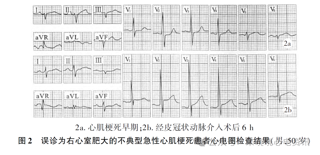 不典型急性心肌梗死心电图误诊分析