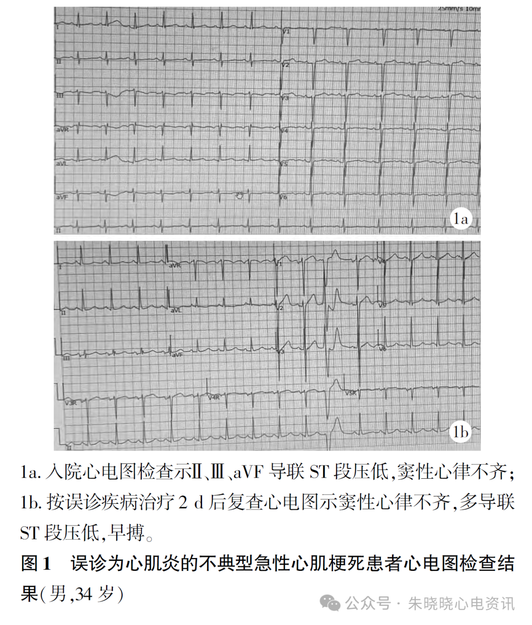 不典型急性心肌梗死心电图误诊分析