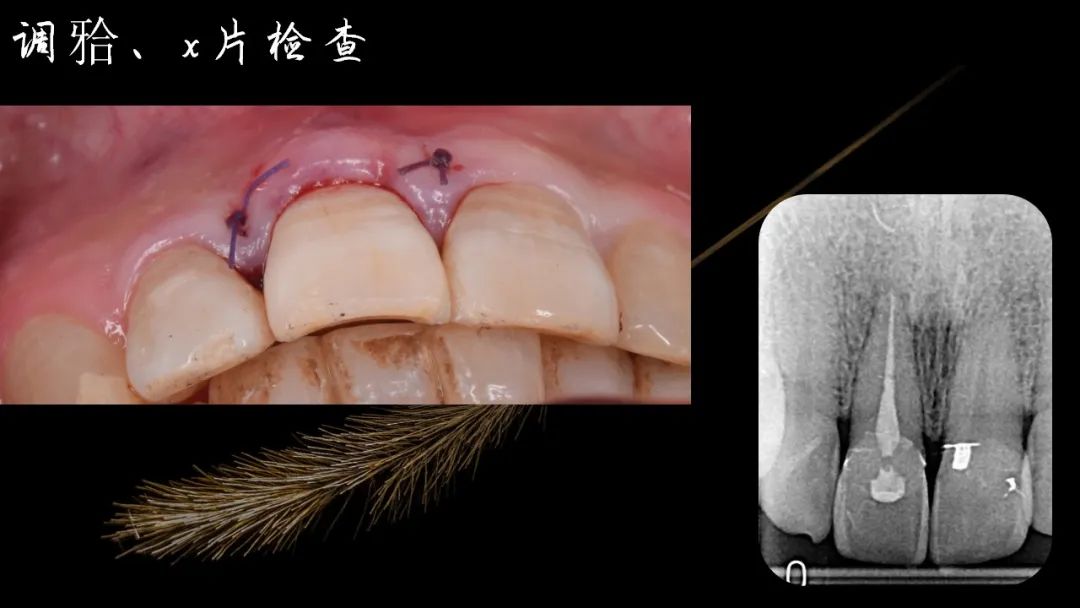 前牙断牙粘接详细流程案例（决策+选择）