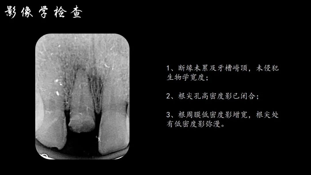 前牙断牙粘接详细流程案例（决策+选择）