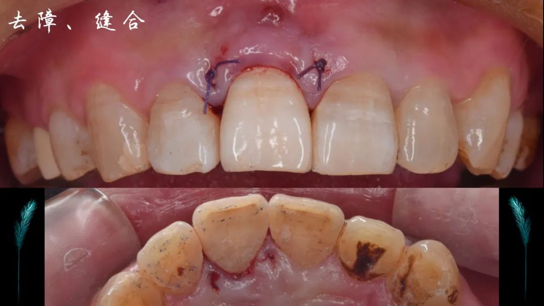 前牙断牙粘接详细流程案例（决策+选择）