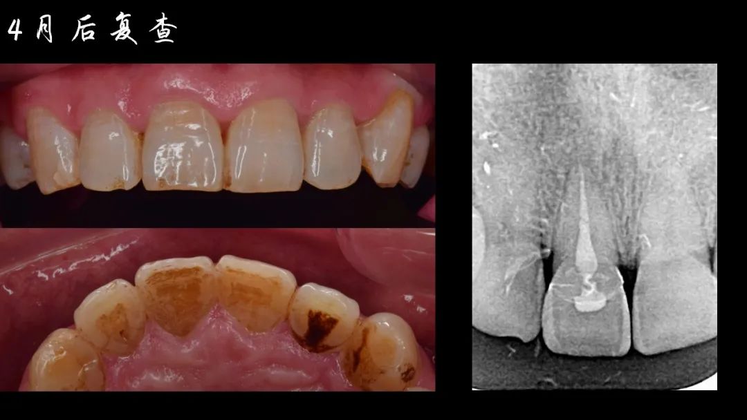 前牙断牙粘接详细流程案例（决策+选择）