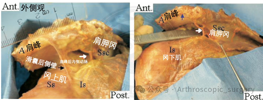 【手术技术】肩峰下周围血管的解剖