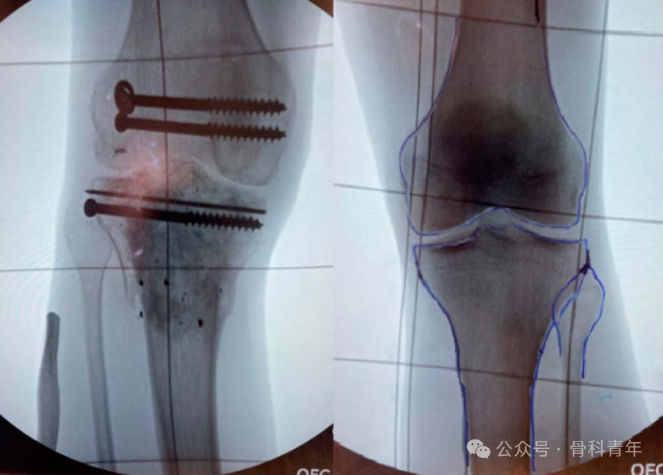 介绍一种术中评估骨折是否复位的技巧：“透明胶片法”