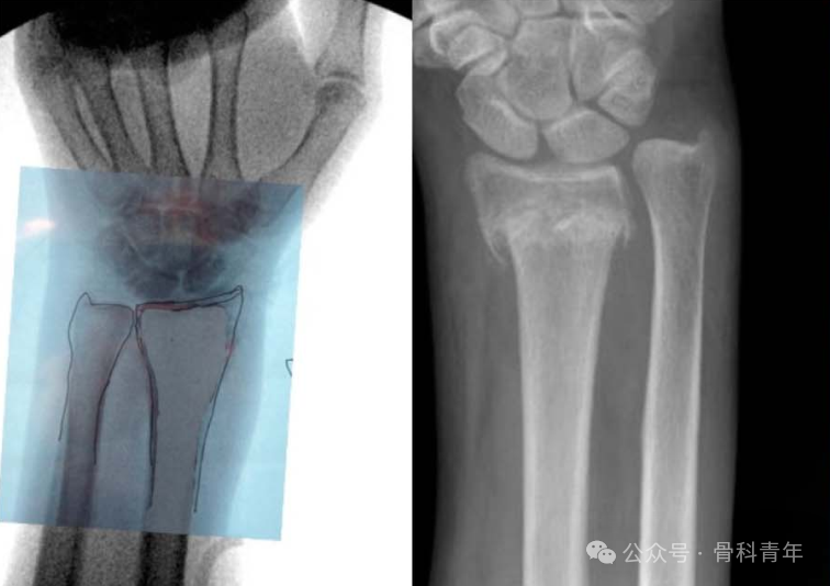 介绍一种术中评估骨折是否复位的技巧：“透明胶片法”