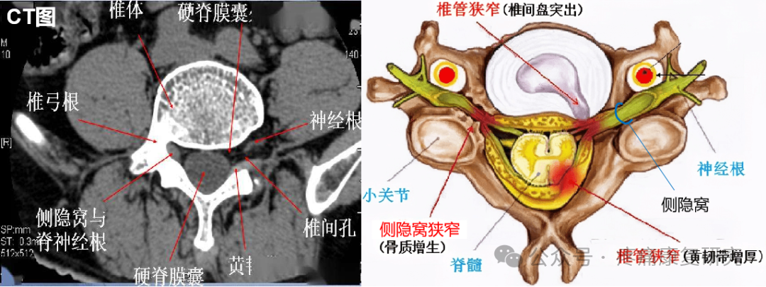 侧隐窝狭窄的详细解剖和诊疗