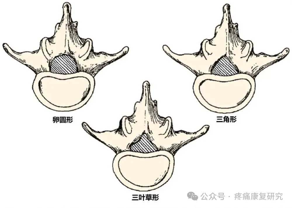 侧隐窝狭窄的详细解剖和诊疗