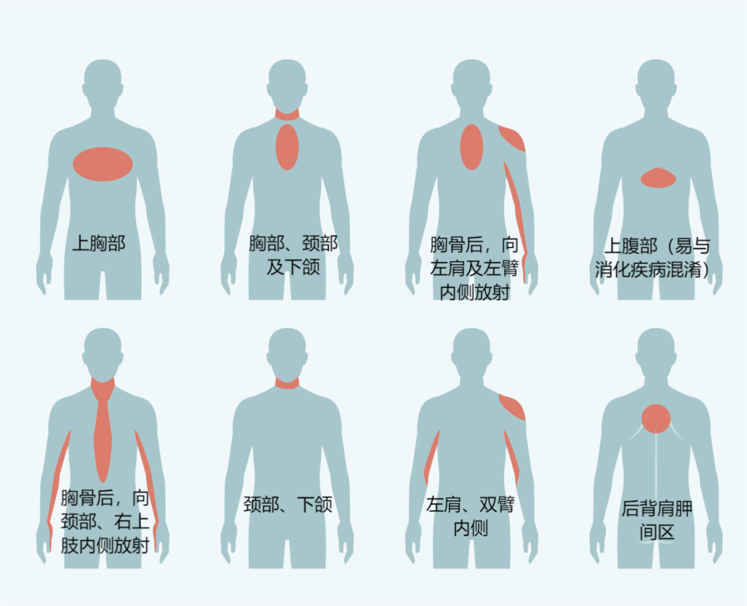 不止胸骨后！典型心绞痛位置，这9个字概括全了