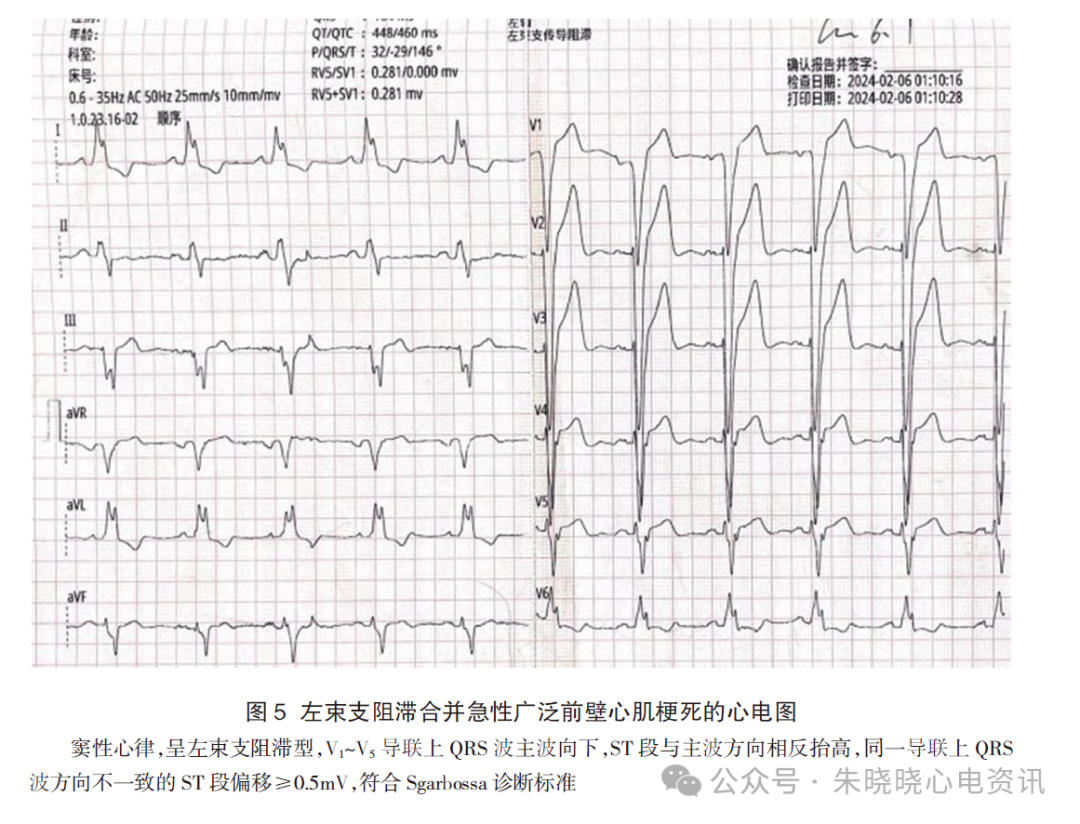 左束支阻滞合并急性心肌梗死的心电图诊断