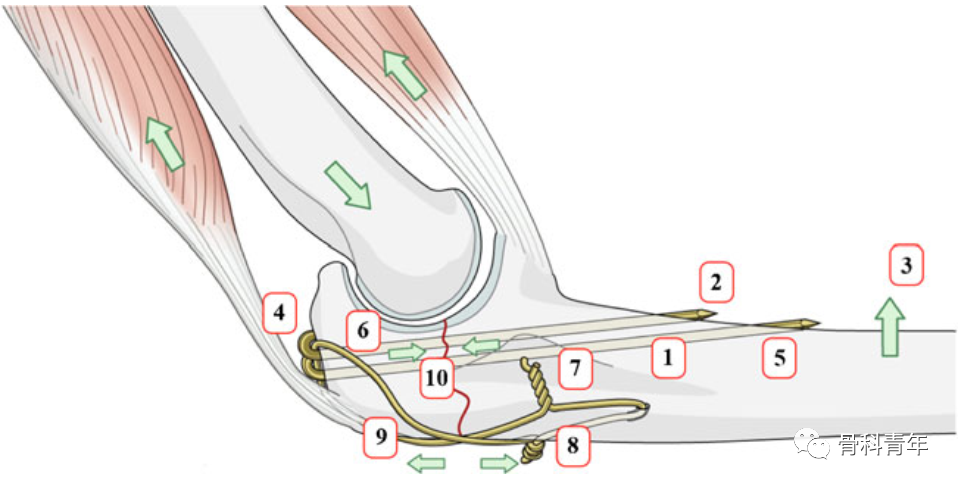 【手术技巧】尺骨鹰嘴骨折克氏针张力带固定的10大技术缺陷
