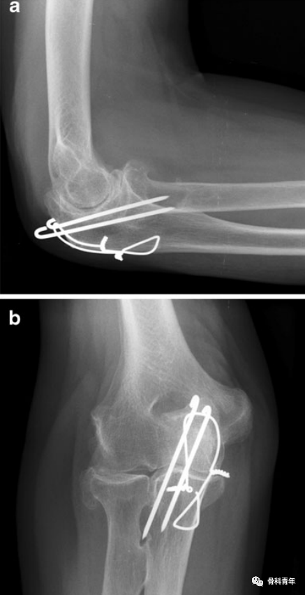 【手术技巧】尺骨鹰嘴骨折克氏针张力带固定的10大技术缺陷