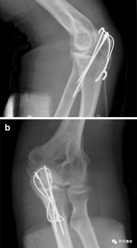【手术技巧】尺骨鹰嘴骨折克氏针张力带固定的10大技术缺陷