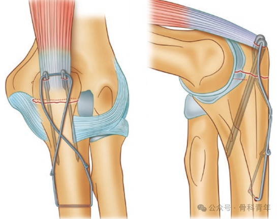 【手术技巧】尺骨鹰嘴骨折克氏针张力带固定的10大技术缺陷