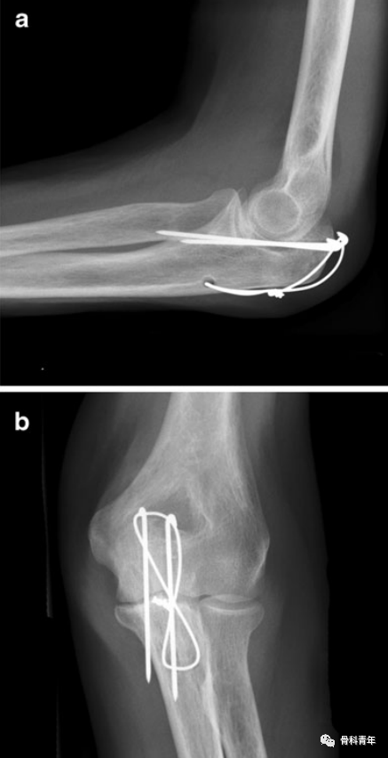【手术技巧】尺骨鹰嘴骨折克氏针张力带固定的10大技术缺陷
