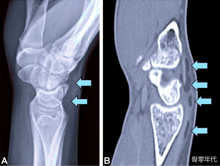 腕伸肌腱“浮脂”征象:桡骨远端隐匿性骨折