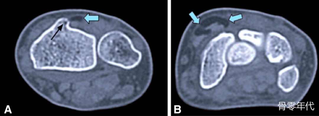 腕伸肌腱“浮脂”征象:桡骨远端隐匿性骨折