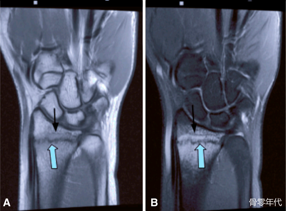 腕伸肌腱“浮脂”征象:桡骨远端隐匿性骨折