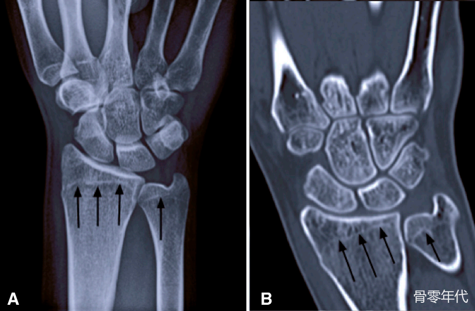腕伸肌腱“浮脂”征象:桡骨远端隐匿性骨折