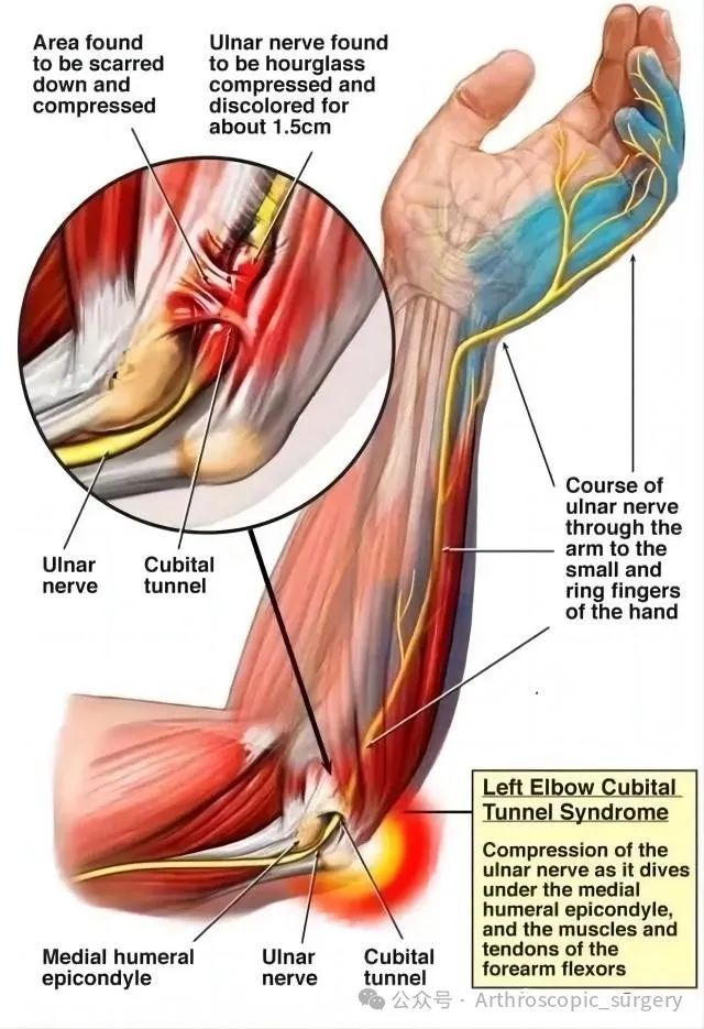 【手术技术】肘关节镜技术系列——尺神经处理