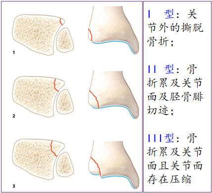 图文详解Tillaux骨折的诊治