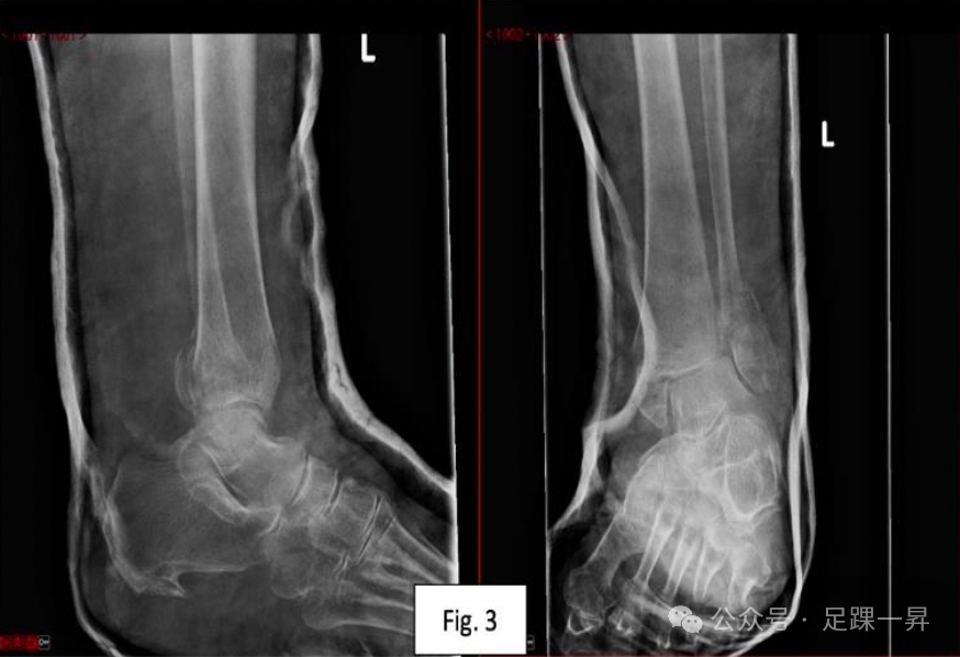 【手术技巧】胫骨加强螺钉技术（Pro-Tibial