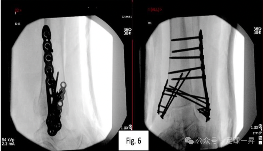 【手术技巧】胫骨加强螺钉技术（Pro-Tibial