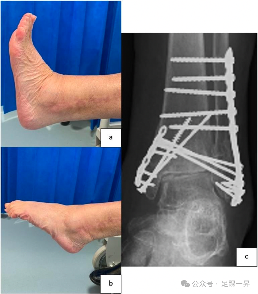 【手术技巧】胫骨加强螺钉技术（Pro-Tibial