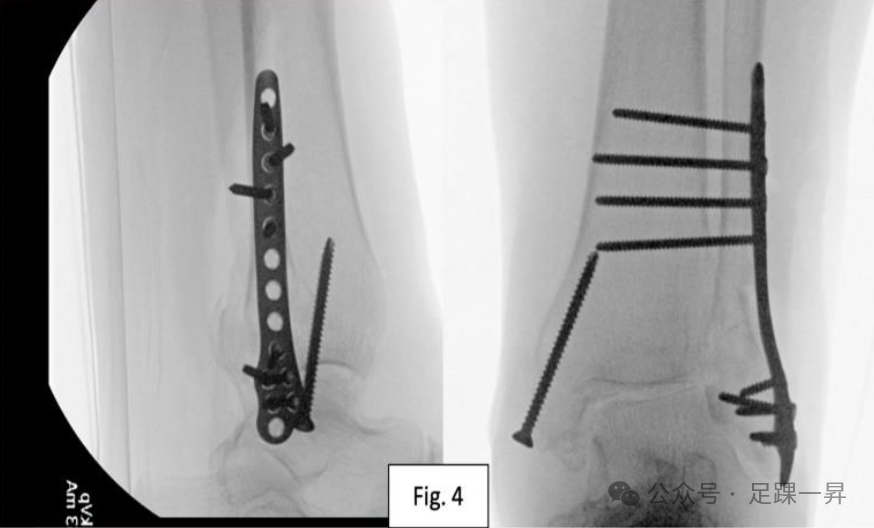 【手术技巧】胫骨加强螺钉技术（Pro-Tibial