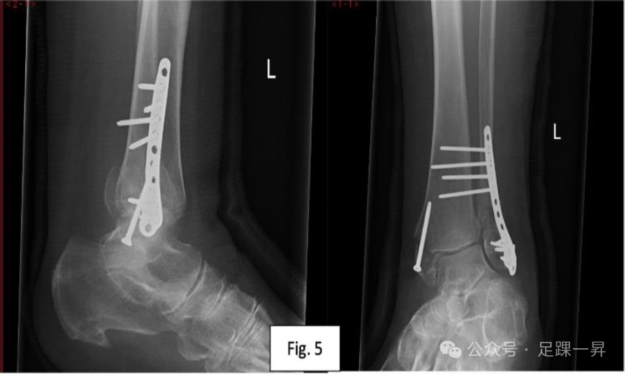 【手术技巧】胫骨加强螺钉技术（Pro-Tibial