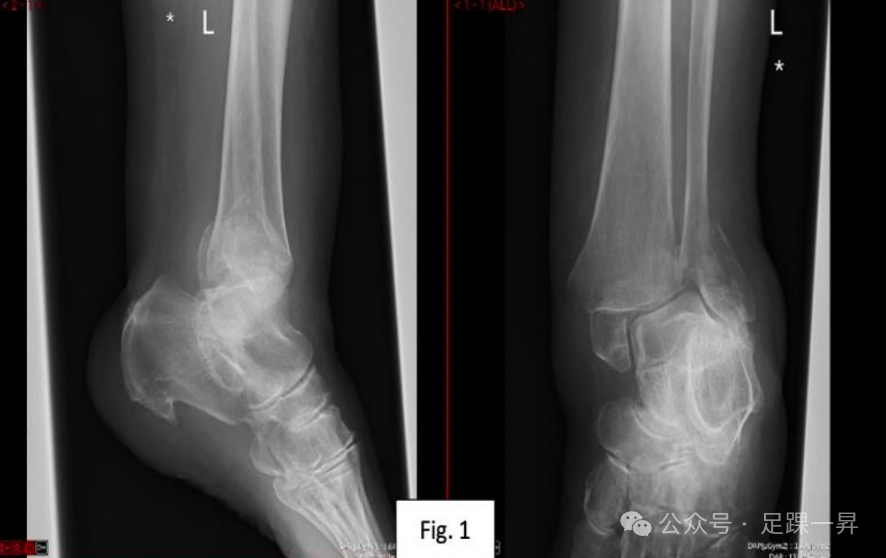 【手术技巧】胫骨加强螺钉技术（Pro-Tibial