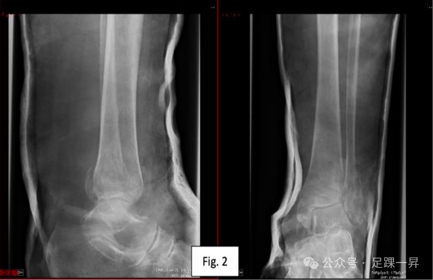 【手术技巧】胫骨加强螺钉技术（Pro-Tibial