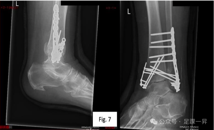 【手术技巧】胫骨加强螺钉技术（Pro-Tibial