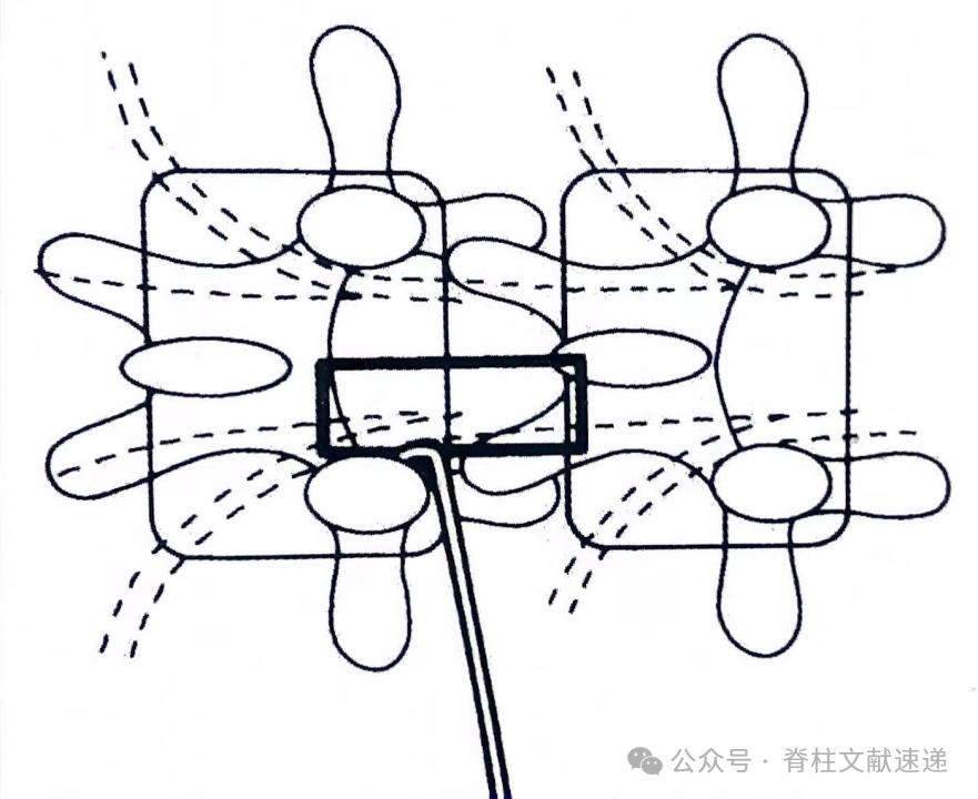 重温经典，解读腰椎髓核摘除术