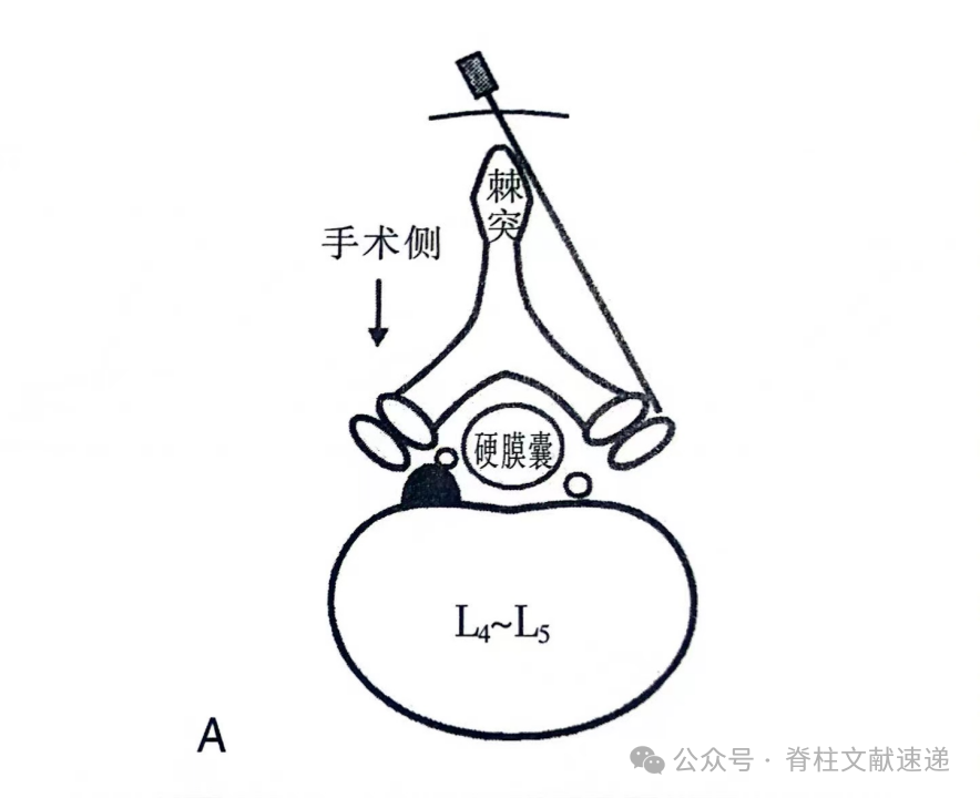 重温经典，解读腰椎髓核摘除术