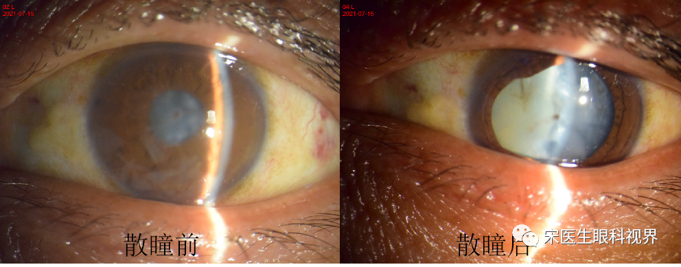 病例分享：一例角膜穿通伤合并外伤性白内障的治疗