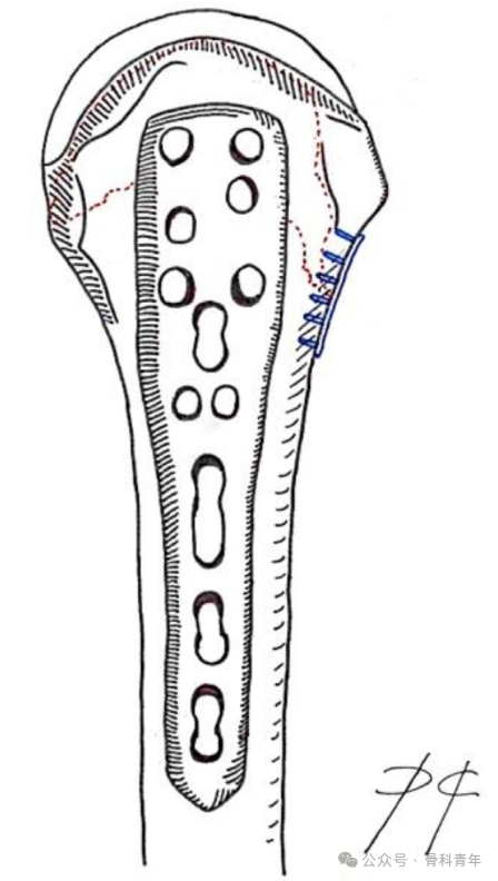 介绍3种复杂肱骨近端骨折的“双钢板”内固定方法