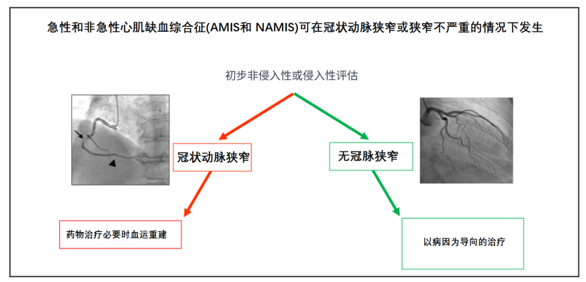 建议冠心病改名为心肌缺血综合征！Circulation和欧洲心脏杂志同期刊登文章