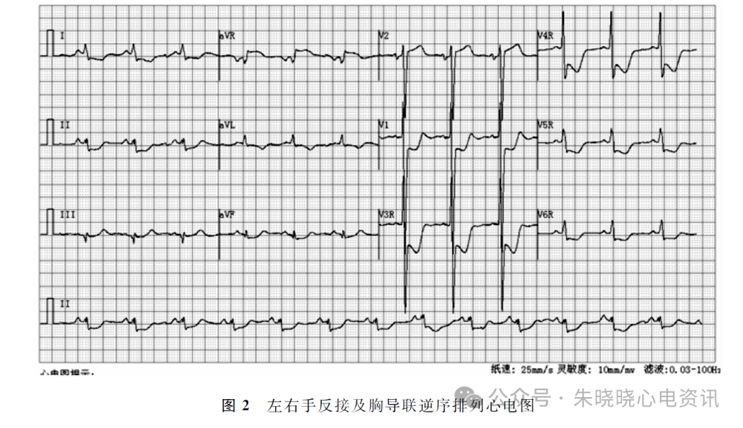 镜像右位心合并急性非ＳＴ段抬高型心肌梗死