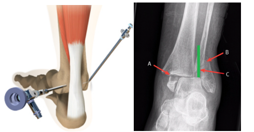 后踝骨折复位如何可视化：关节镜来助力