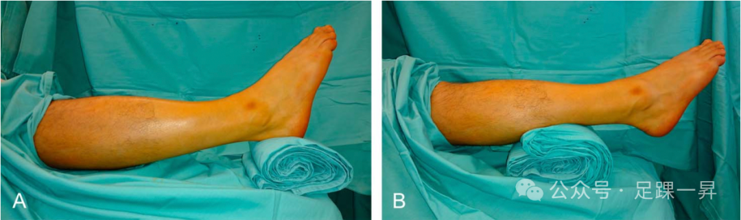 【手术技巧】下胫腓联合复位和固定时到底踝关节放什么位置？