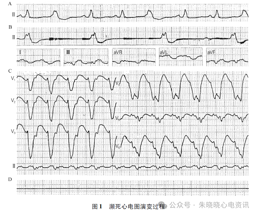 濒死心电图的演变与解读价值