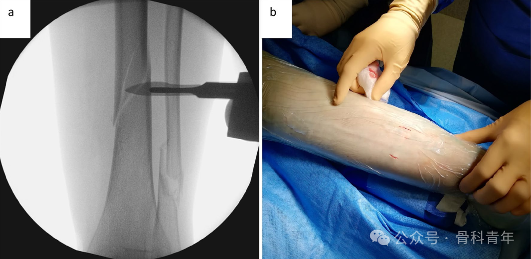 早读｜【手术技巧】微创“钢丝环扎术”辅助固定胫骨干螺旋形骨折