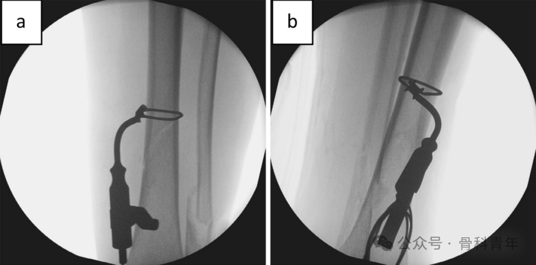 早读｜【手术技巧】微创“钢丝环扎术”辅助固定胫骨干螺旋形骨折