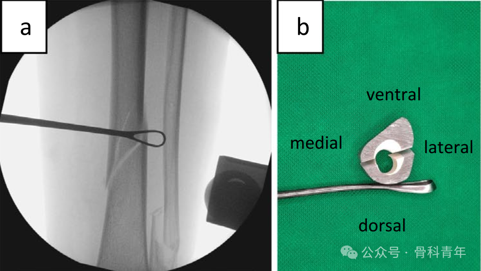 早读｜【手术技巧】微创“钢丝环扎术”辅助固定胫骨干螺旋形骨折