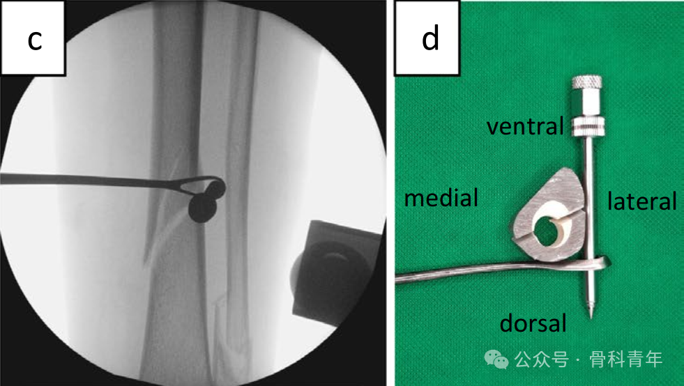 早读｜【手术技巧】微创“钢丝环扎术”辅助固定胫骨干螺旋形骨折
