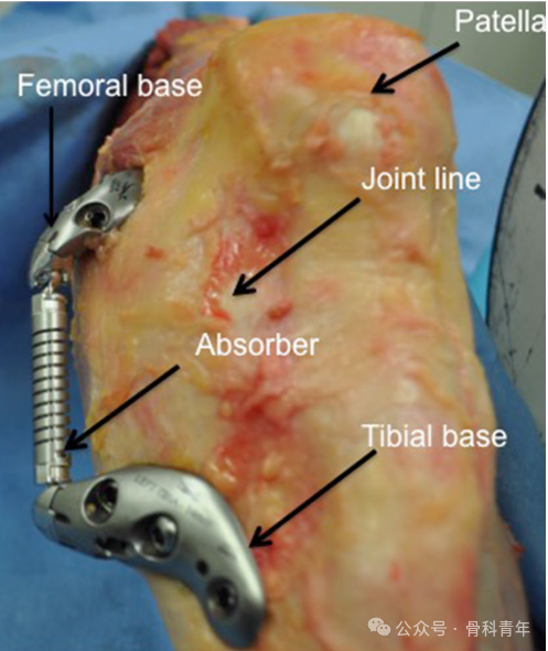 “膝关节减震器”，能否引领膝关节OA的技术革新？