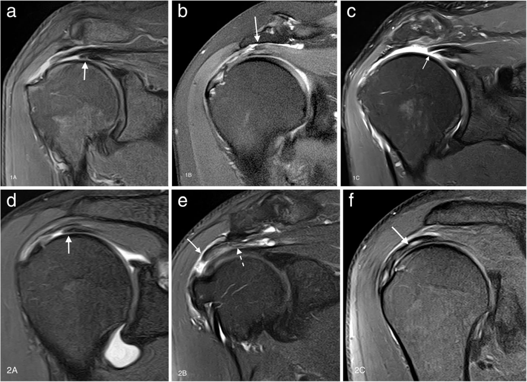 肩袖撕裂模式：磁共振成像及其手术相关性