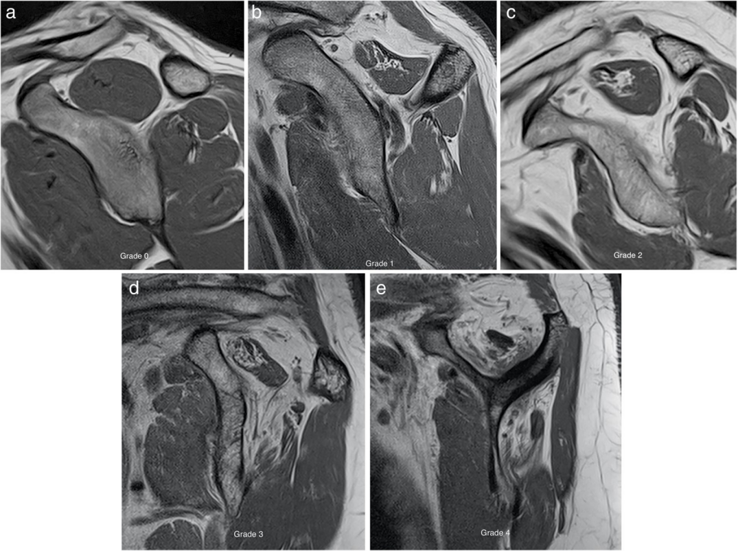 肩袖撕裂模式：磁共振成像及其手术相关性